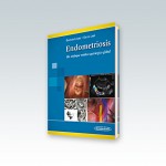 Endometriosis