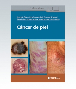 Cáncer de piel. 1ª Edición – 2021