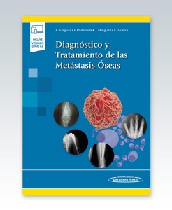 Diagnóstico y Tratamiento de las Metástasis Óseas. 1ª Edición – 2021