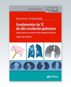 Fundamentos de TC de alta resolución pulmonar. 2ª Edición – 2021