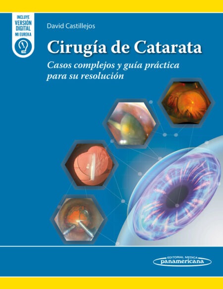 Cirugía de Catarata. Casos complejos y guía práctica para su resolución. 1ª Ed. Incluye eBook